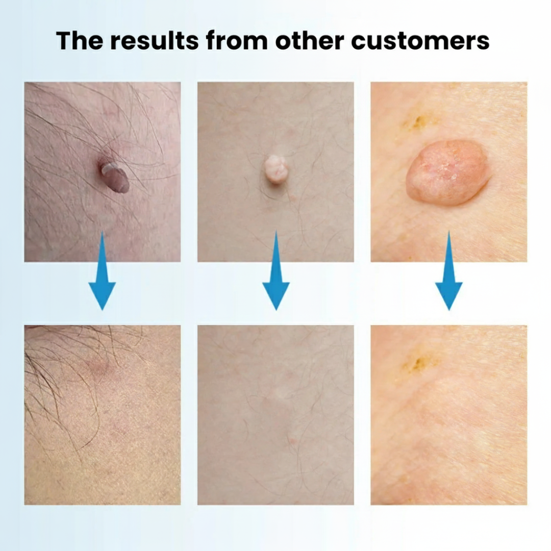 DermaEase Kit | Safely Remove Skin Tags At Home