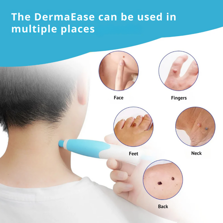 DermaEase Kit | Safely Remove Skin Tags At Home