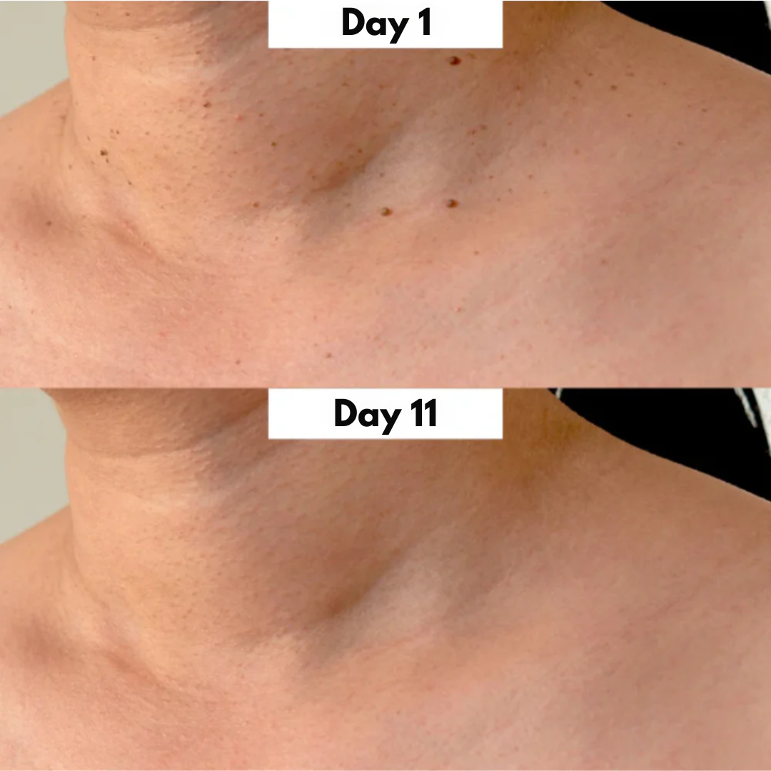 DermaEase Kit | Safely Remove Skin Tags At Home