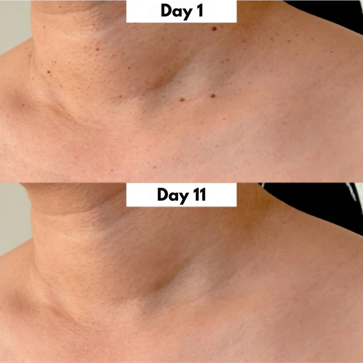 DermaEase Kit | Safely Remove Skin Tags At Home